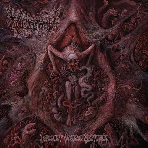 Vulvectomy- Aberrant Vaginal Gestation (Cd) 1